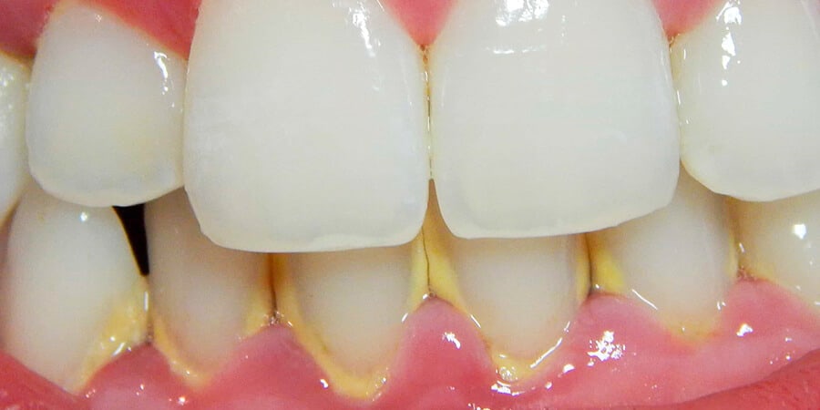 dientes con sarro