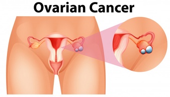 mujer con cáncer de ovarios